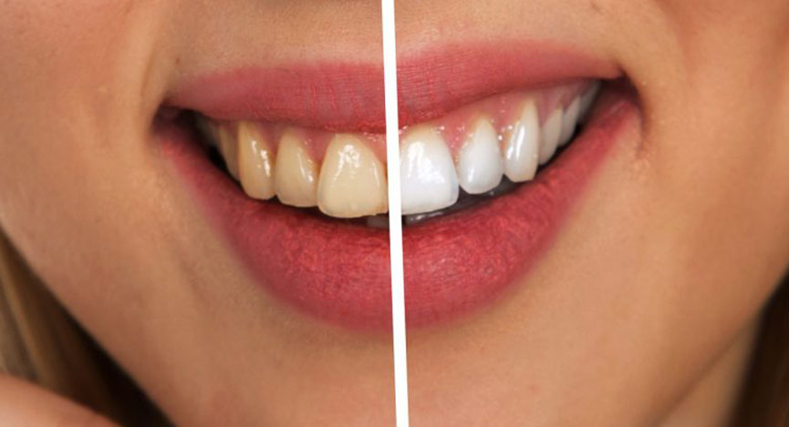 Отбеливание в Харькове