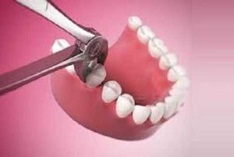 Удаление зубов, удаление зубов мудрости в Харькове