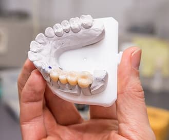 Зубные мосты и зубные коронки в Харькове